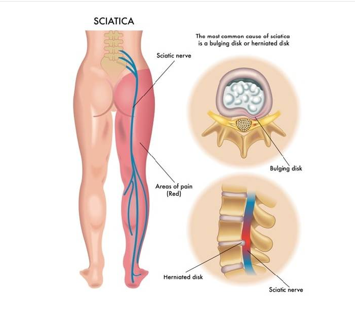 Sciatica