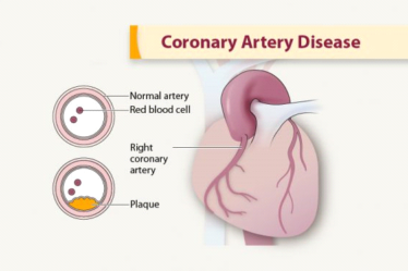 coronary artery disease