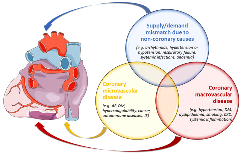 Non-obstructive Coronary Artery Disease