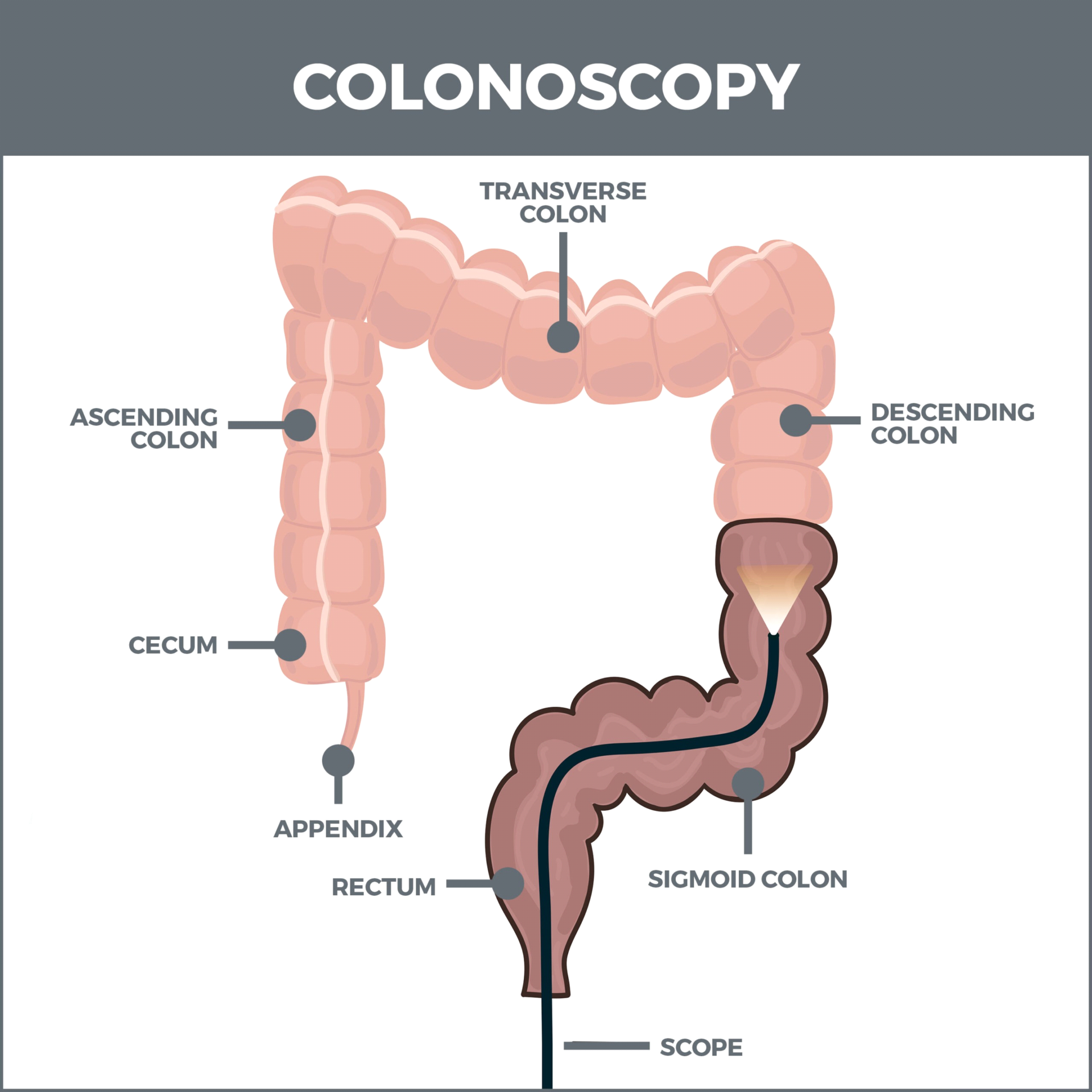 colonnscopy /colon