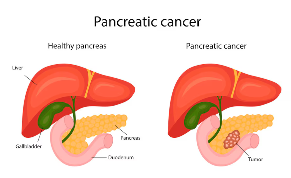 pancrease