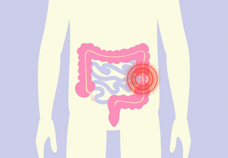 What is irritable bowel syndrome?​