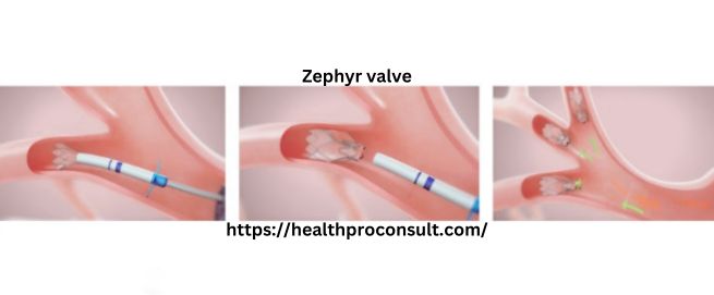 Zephyr valve