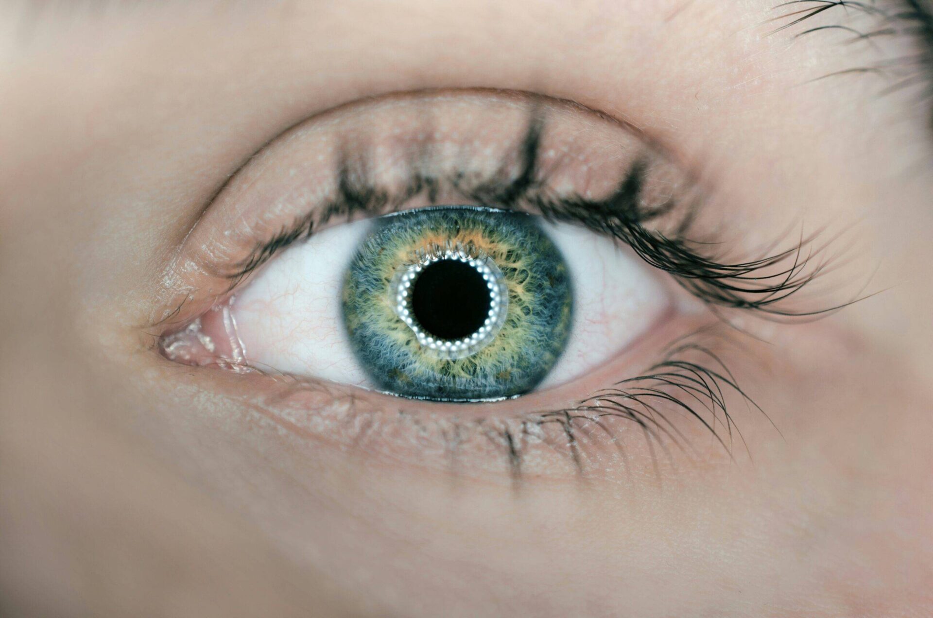 What is keratoplasty?