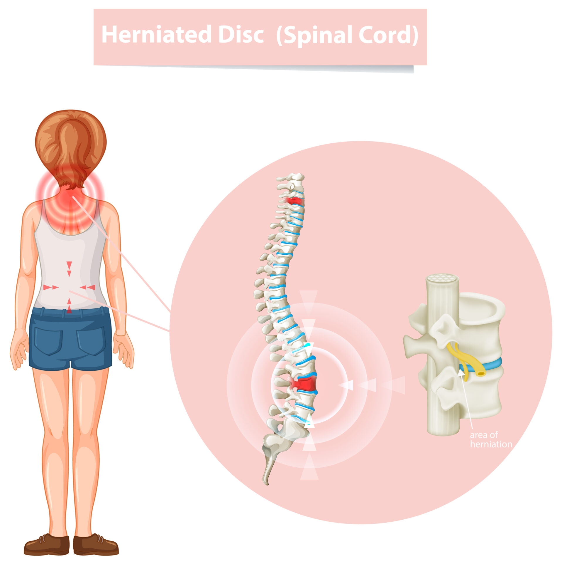 herniated dise