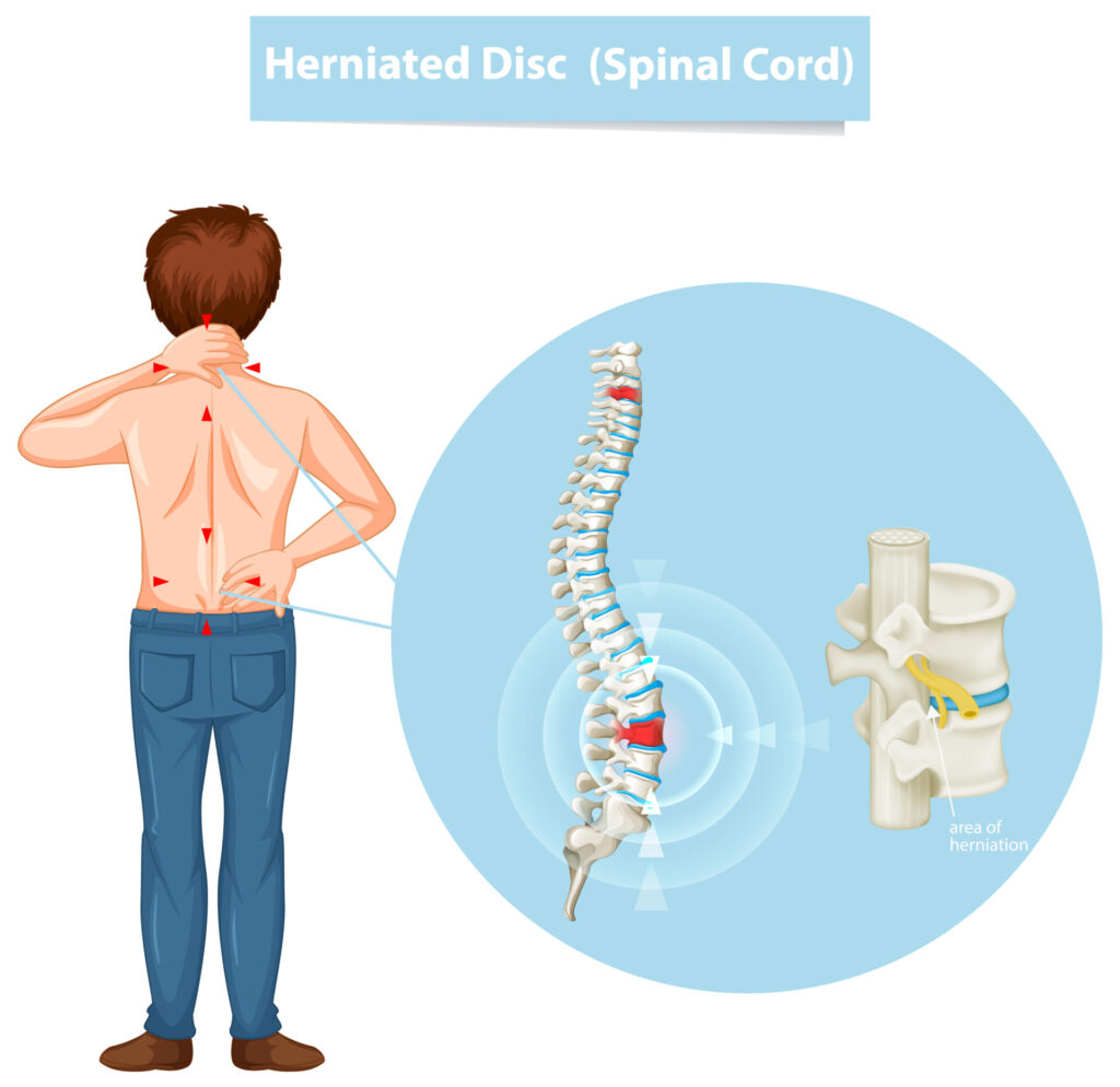 Can you get disability for herniated disc
