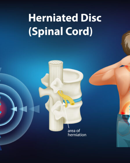 Can i run with a herniated disc