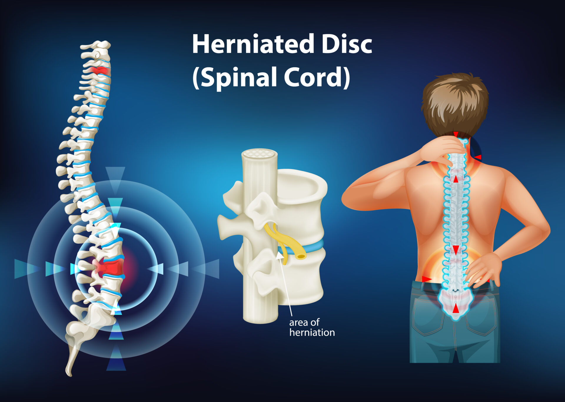 Can i run with a herniated disc